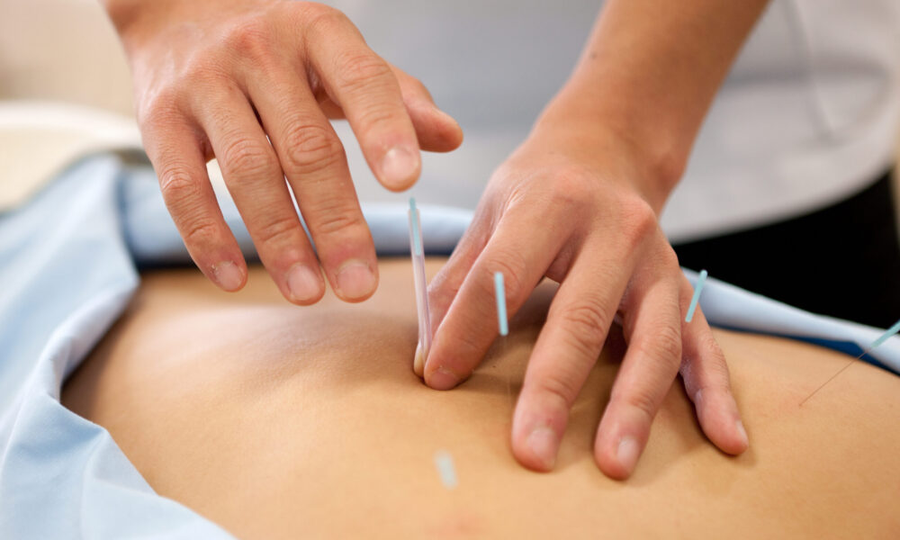 鍼灸・鍼治療